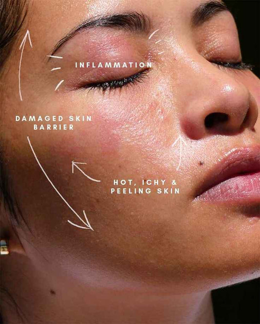 Your Skin NOT Sensitive — Your Barrier Is Damaged - Koraya Beauty