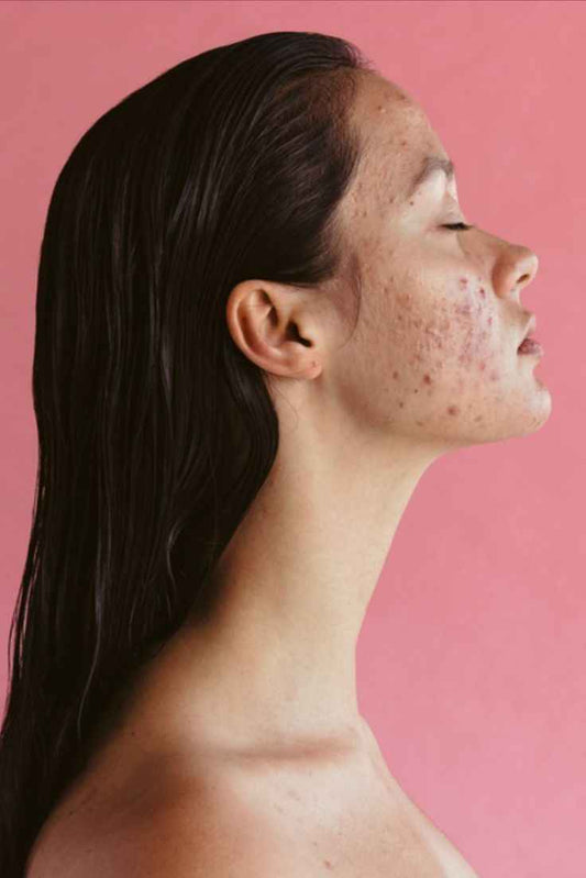Acne Is Not Dirty Skin — It’s Inflamed Skin - Koraya Beauty