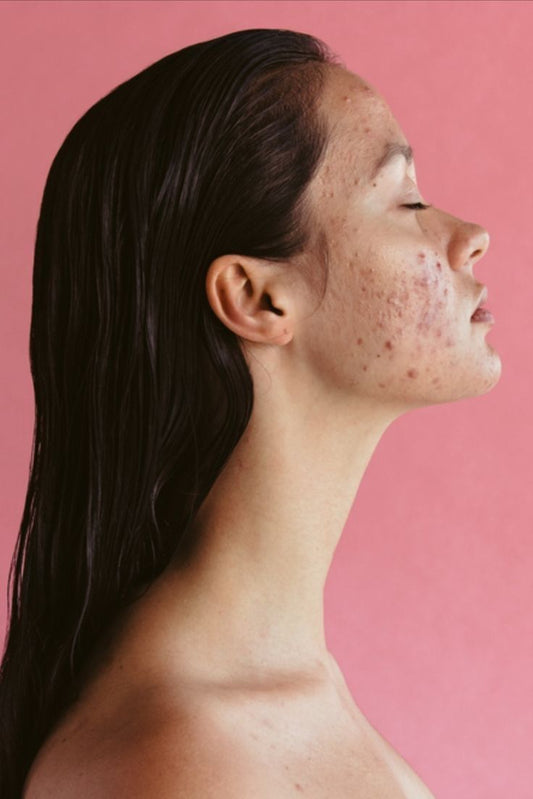 Acne Is Not Dirty Skin — It’s Inflamed Skin