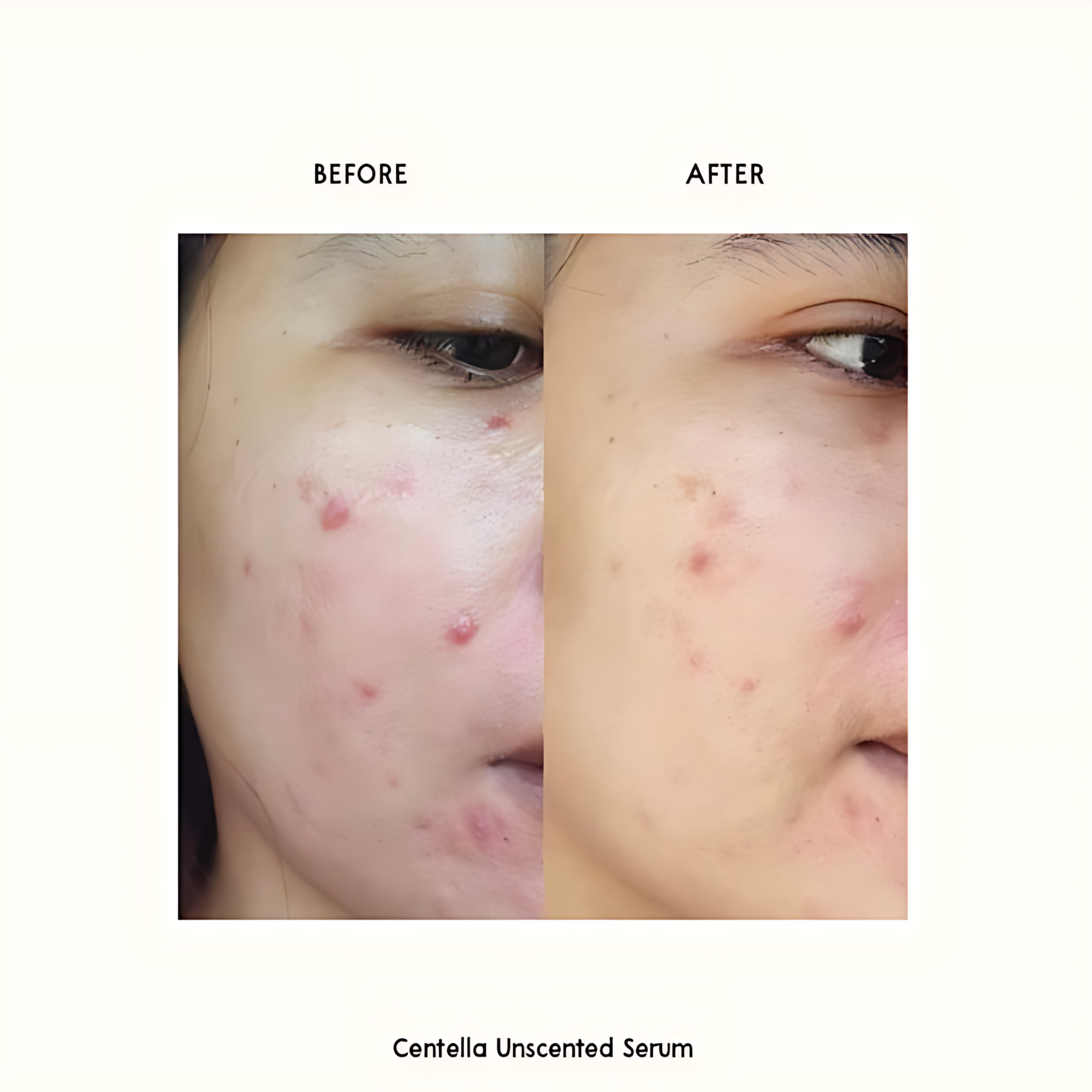 PURITO Centella Unscented Serum, 34,860 ppm Centella, Facial Serum for Sensitive Skin & Acne-Prone Skin, Soothing Serum - Koraya Beauty